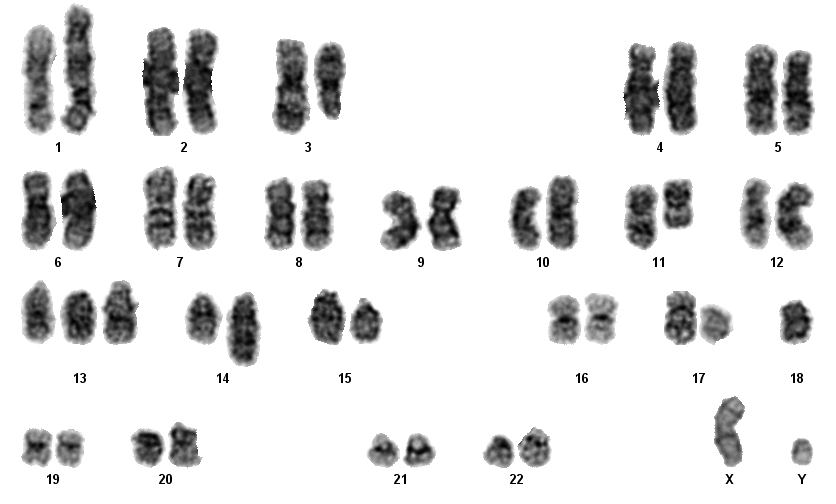 Second Recurrence Conventional Cytogenetics